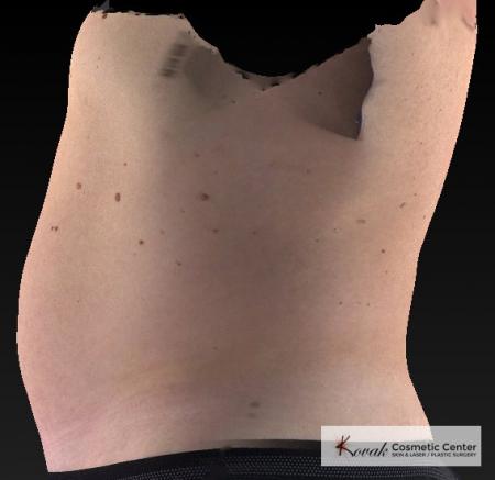 CoolSculpting®: Patient 19 - Before 2