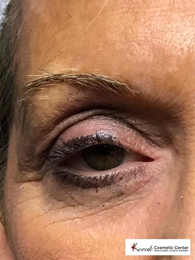 Modified Botox Brow Raise on a 64 year old Woman - Before 