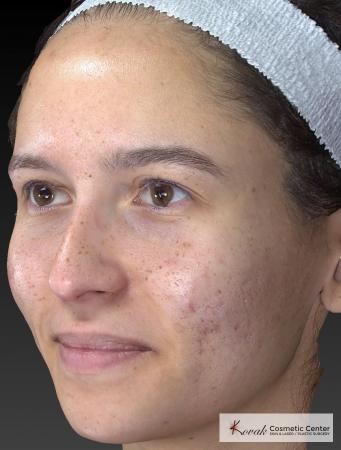 Venus Viva: Patient 3 - Before Image 3