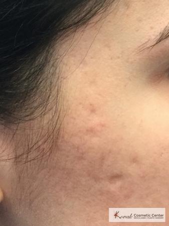 Acne Scars treated with Venus Viva on 28 year old woman - Before Image 1