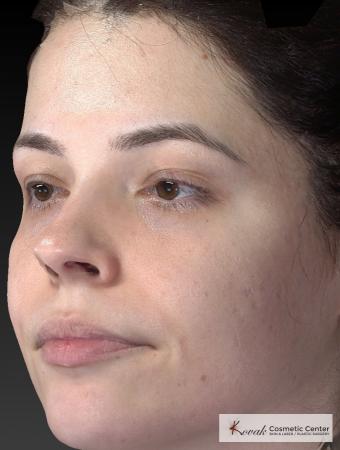 Venus Viva: Patient 4 - After Image 3