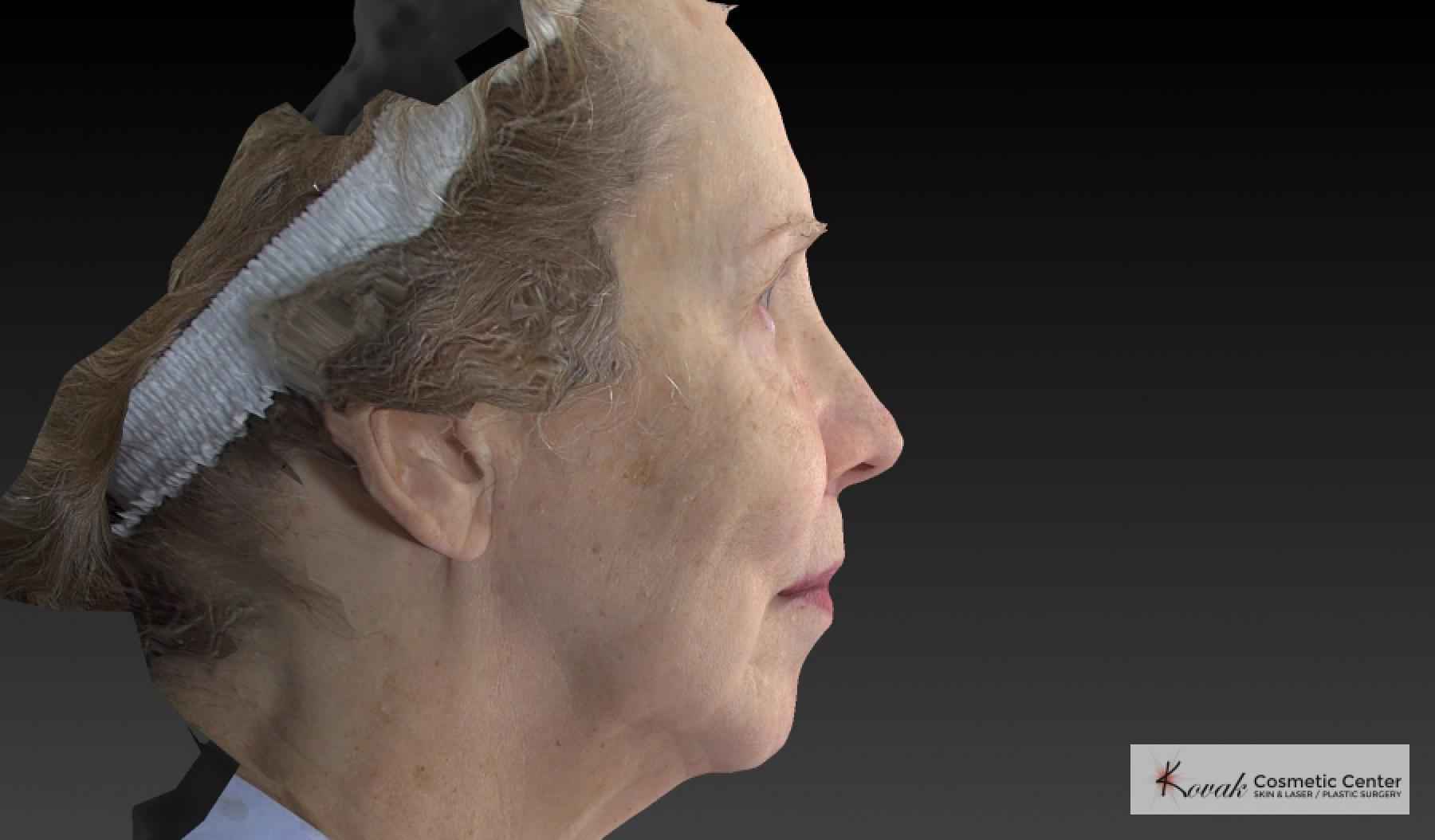 Sculptra®: Patient 3 - Before 