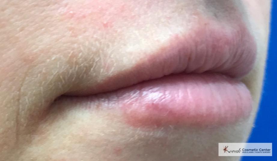 Restylane®: Patient 2 - After 2