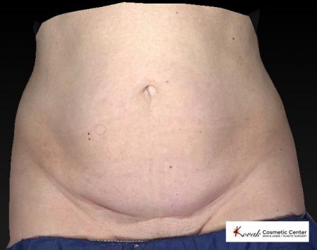 CoolSculpting®: Patient 12 - Before