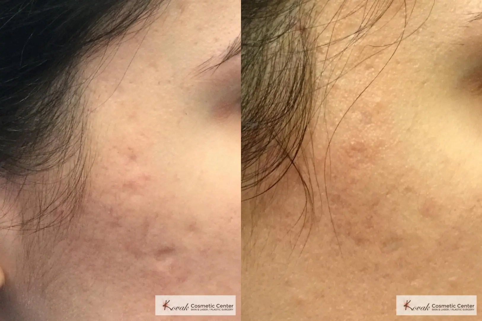 Acne Scars treated with Venus Viva and Juvederm on 28 year old woman - Before and After  