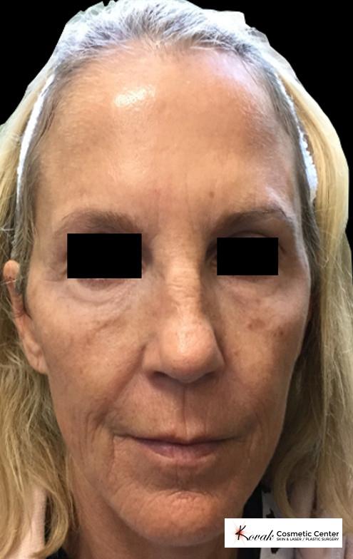 Laser Skin Resurfacing - Face: Patient 1 - Before 