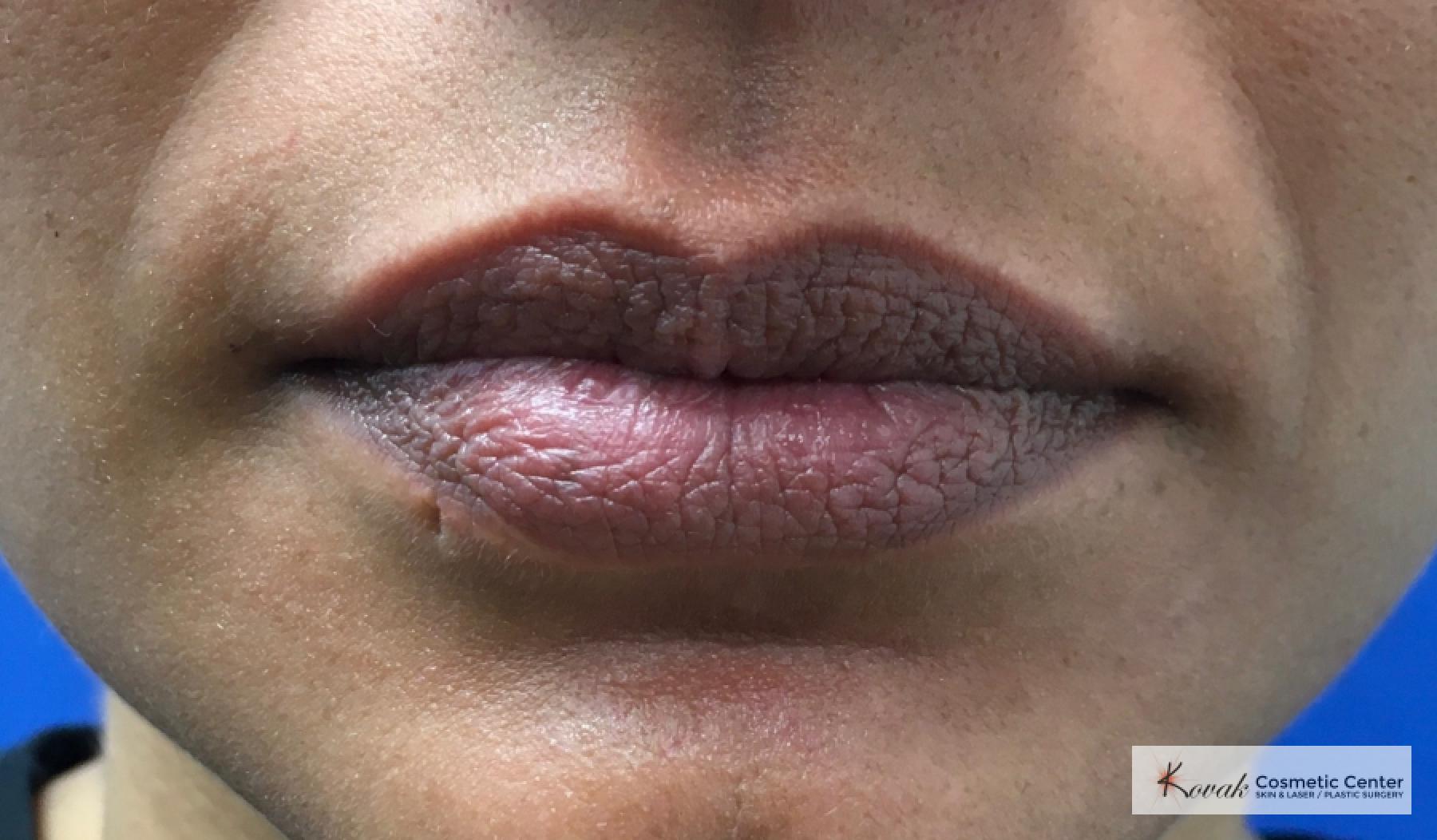 Restylane Kysse Treatment on a 37 year old female to fill the lips - Before 