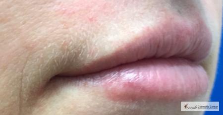 Lip Augmentation: Patient 2 - After Image 2