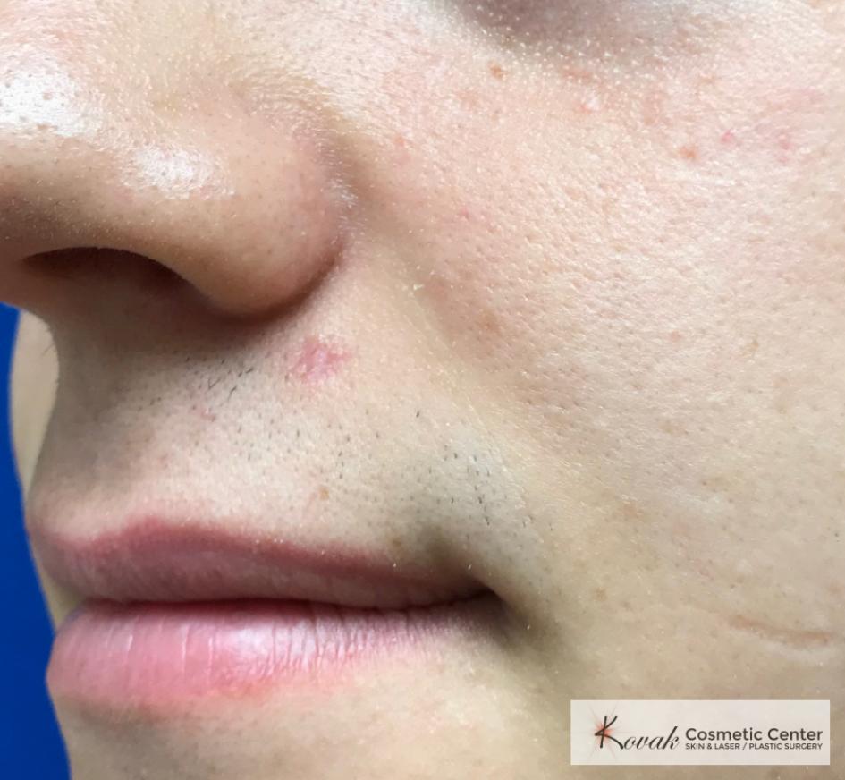 Mole Removal on a 25 Year old Male - After  