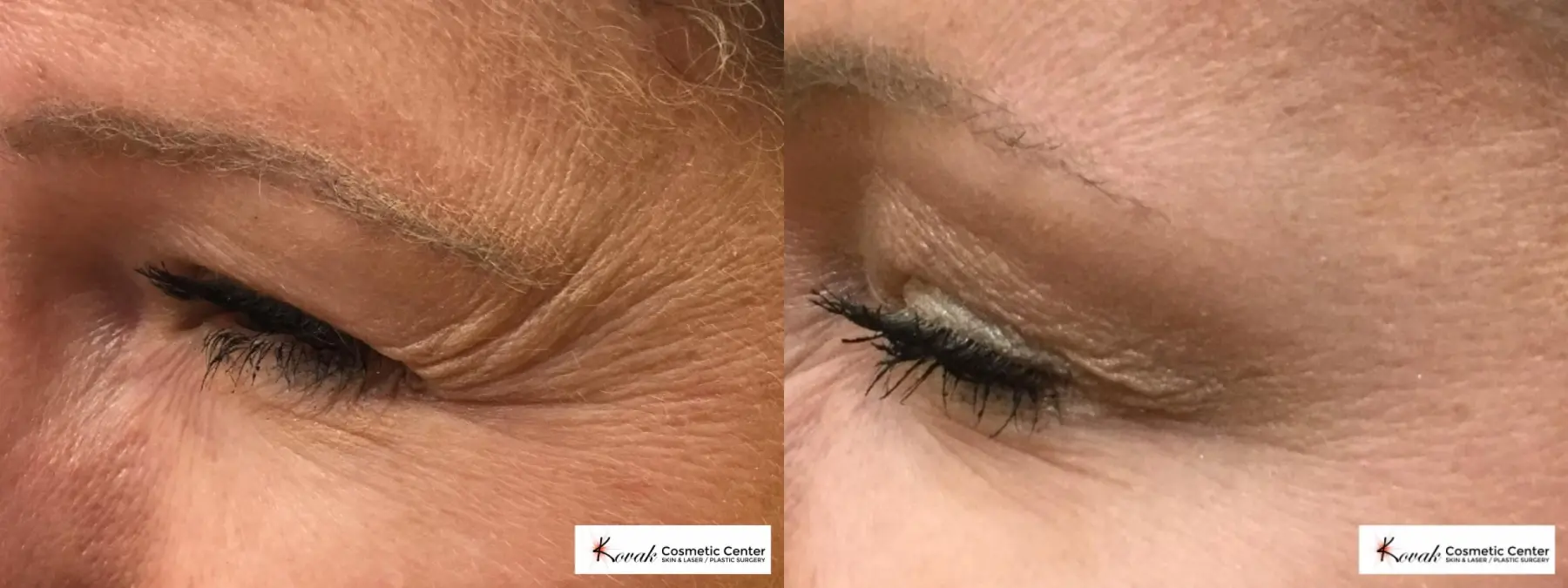Botox for the eyes on a 40 year old woman - Before and After  