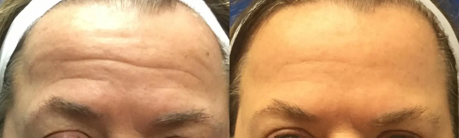 Case 222 - Before and After  
