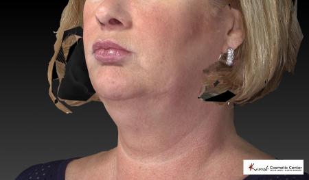 Kybella: Patient 1 - Before Image 3