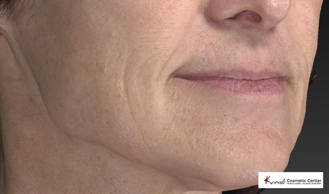 Restylane® Silk: Patient 2 - After 5