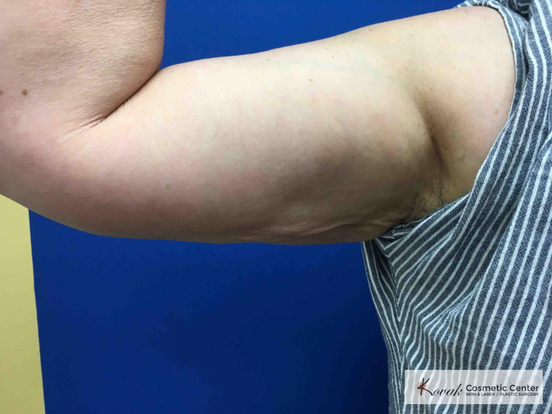 Liposuction: Patient 2 - After  