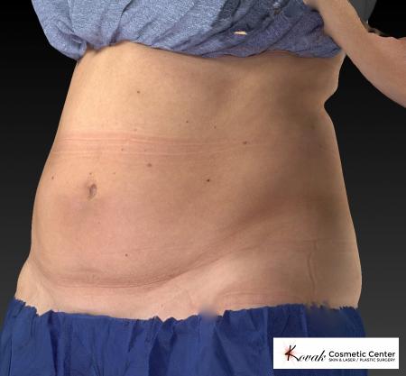 CoolSculpting®: Patient 10 - Before 3