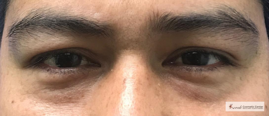 Restylane®: Patient 4 - Before 