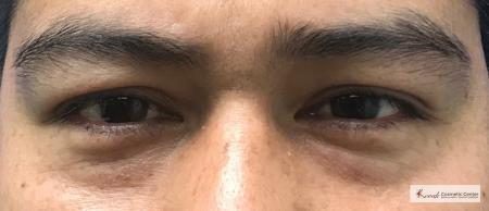 Restylane®: Patient 4 - Before 1