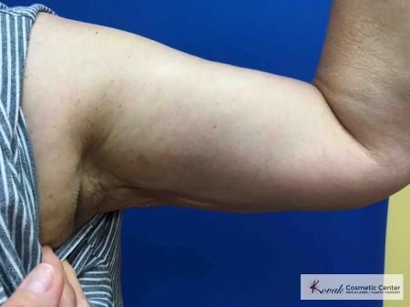 Laser Liposuction: Patient 5 - After 2
