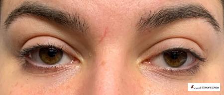 Dark Circle Treatment using Restylane Silk on a 23 year old Female - After 1