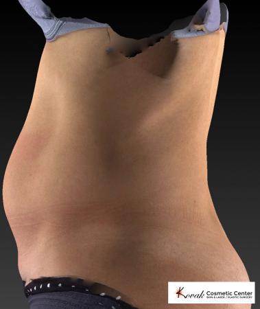 CoolSculpting®: Patient 6 - Before Image 3