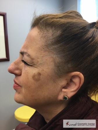 Tyte And Bryte – Face: Patient 2 - Before Image 1