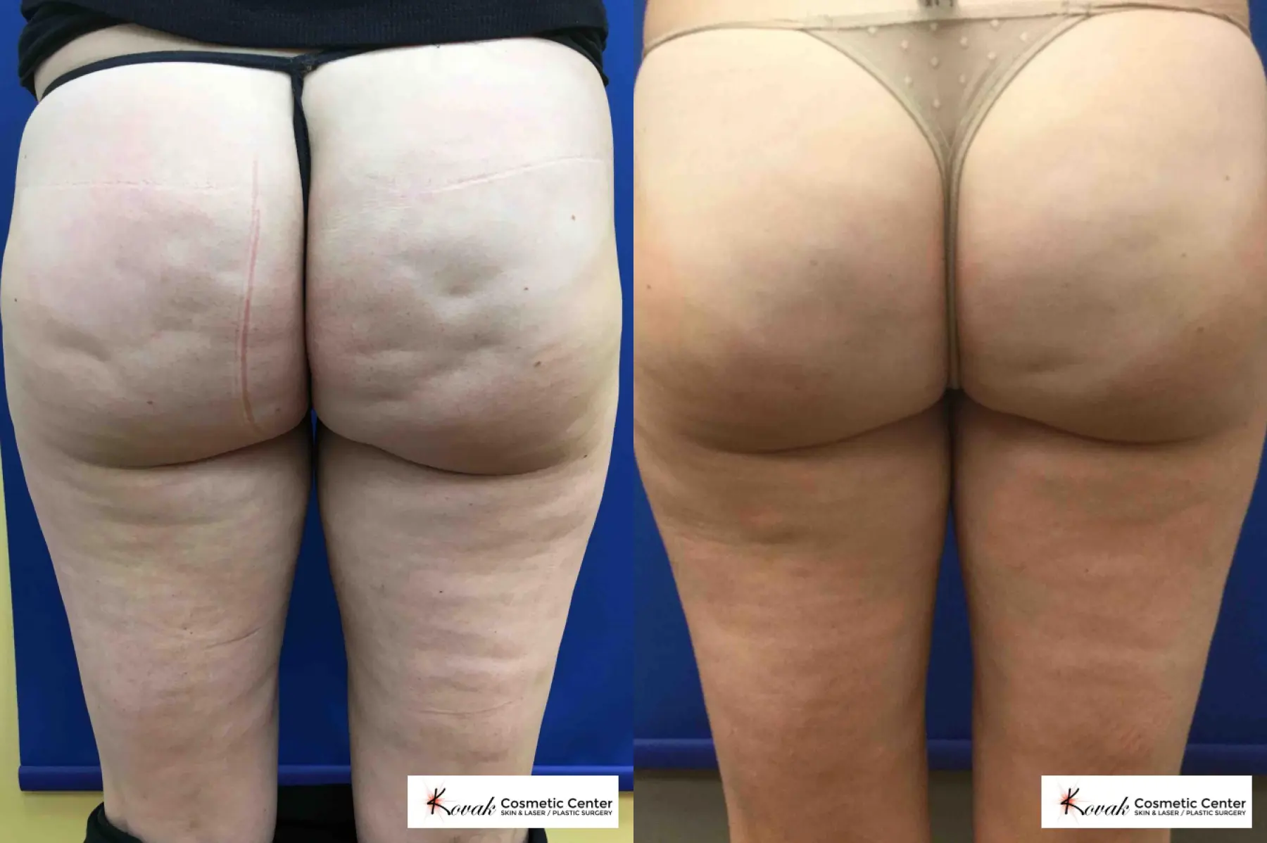 Case 232 - Before and After  