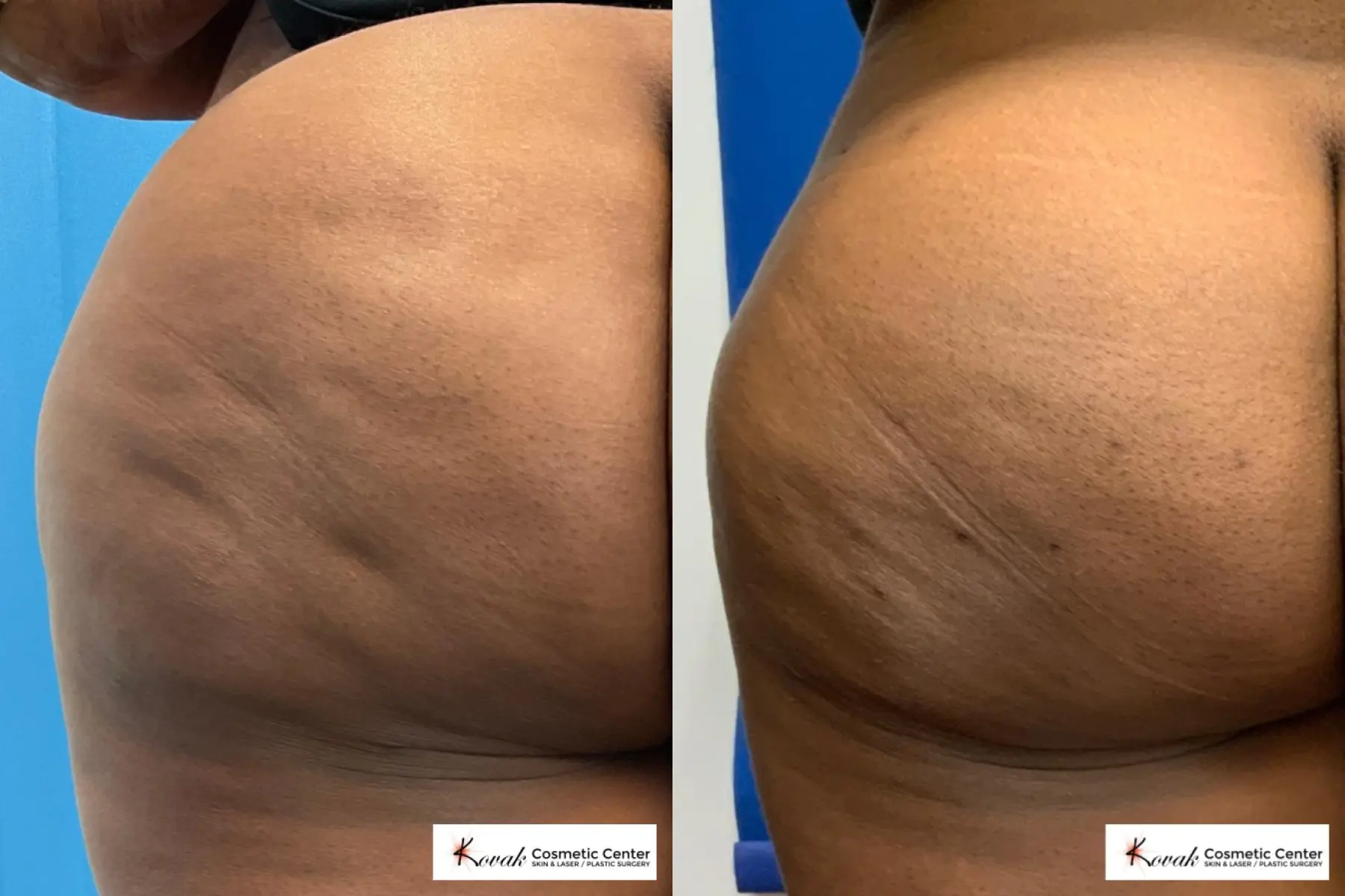 Cellfina treatment on a 45 year old female - Before and After  