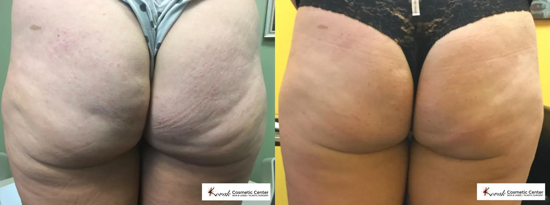 Case 137 - Before and After  