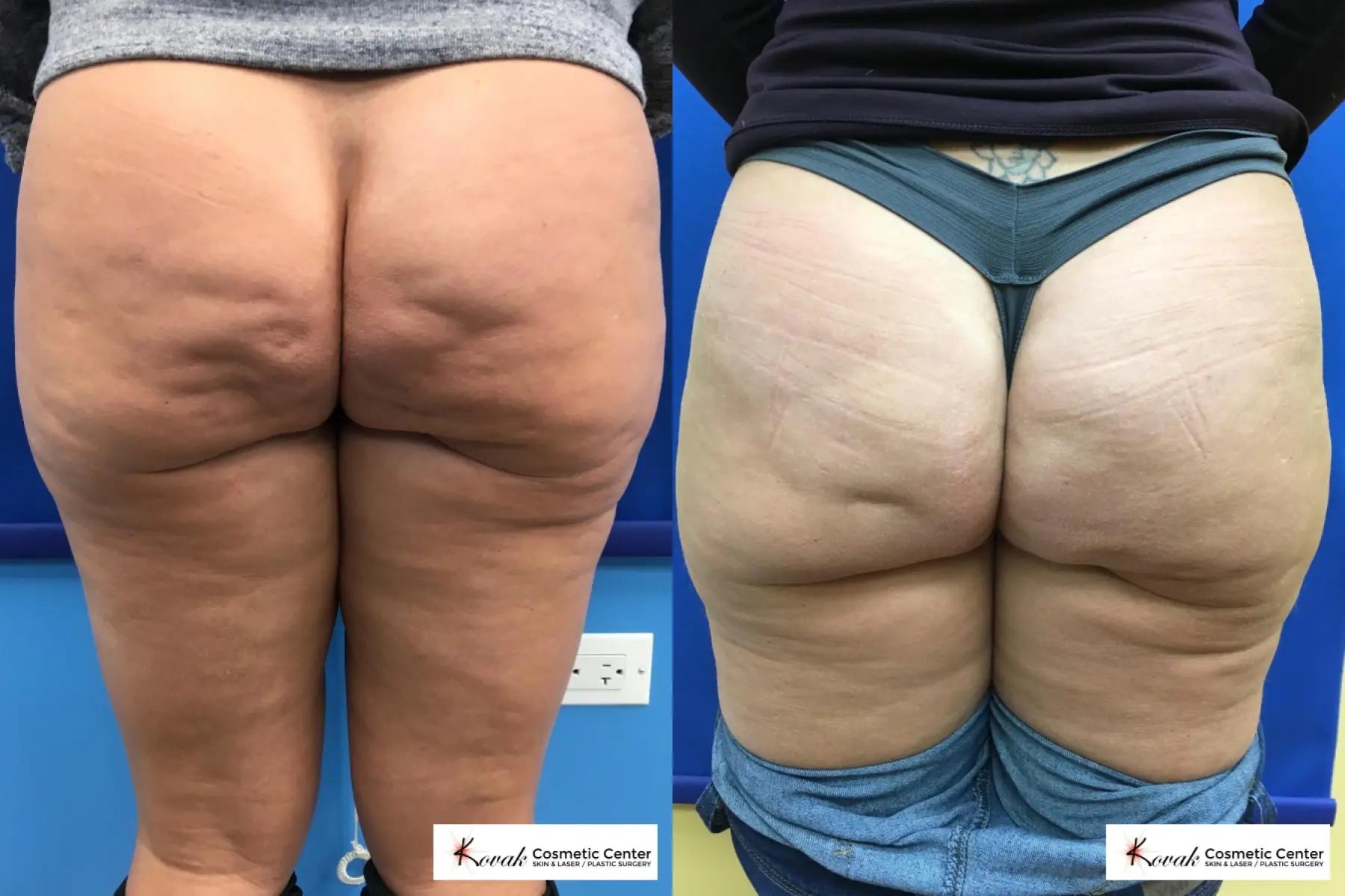 Case 112 - Before and After  