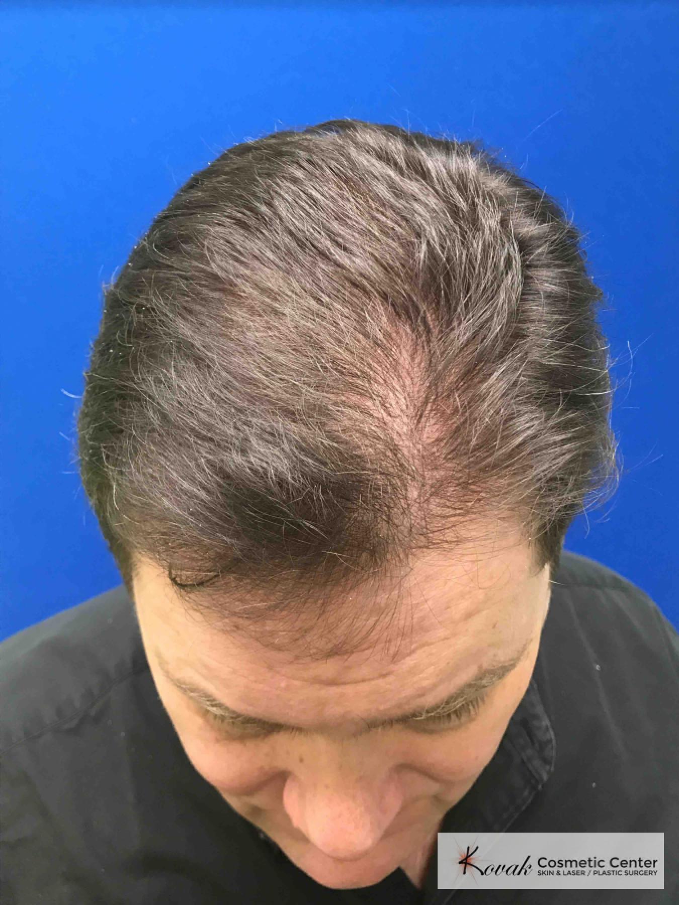 Hair Transplantation: Patient 1 - After  