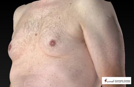 CoolSculpting®: Patient 7 - Before 2