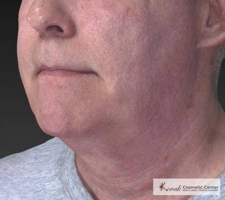 Kybella: Patient 4 - Before Image 3