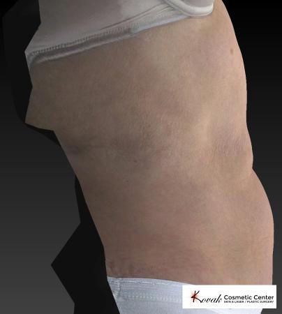 CoolSculpting®: Patient 13 - After 4