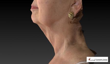 Kybella: Patient 3 - After Image 5