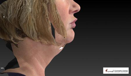 Kybella: Patient 1 - Before and After Image 5
