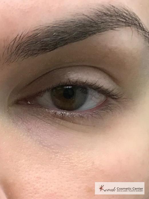 Dark Circle Treatment using Volbella on a 30 year old female - After 2