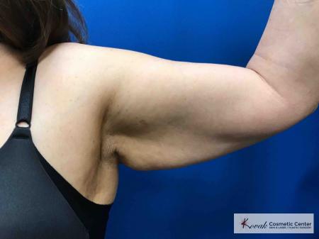 Laser Liposuction: Patient 5 - Before and After 2