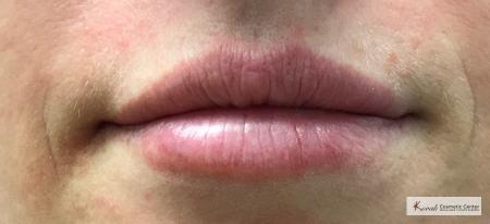 Lip Augmentation: Patient 2 - After Image 3