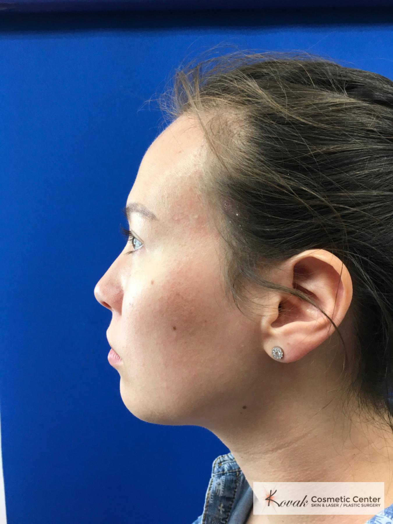 Restylane® Lyft: Patient 2 - Before 