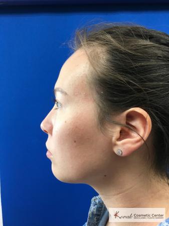 Restylane® Lyft: Patient 2 - Before 1