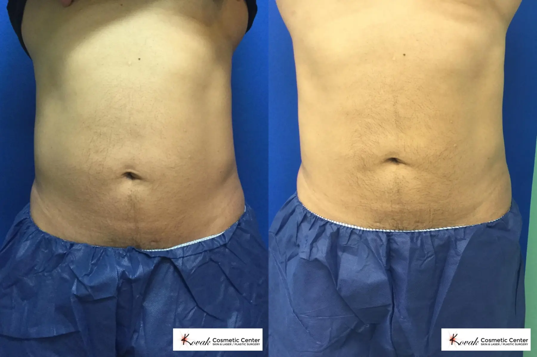 Emsculpt of the abdomen on a 50 year old male - Before and After  