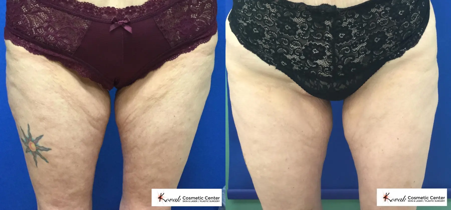 EMSCULPT®: Patient 3 - Before and After  
