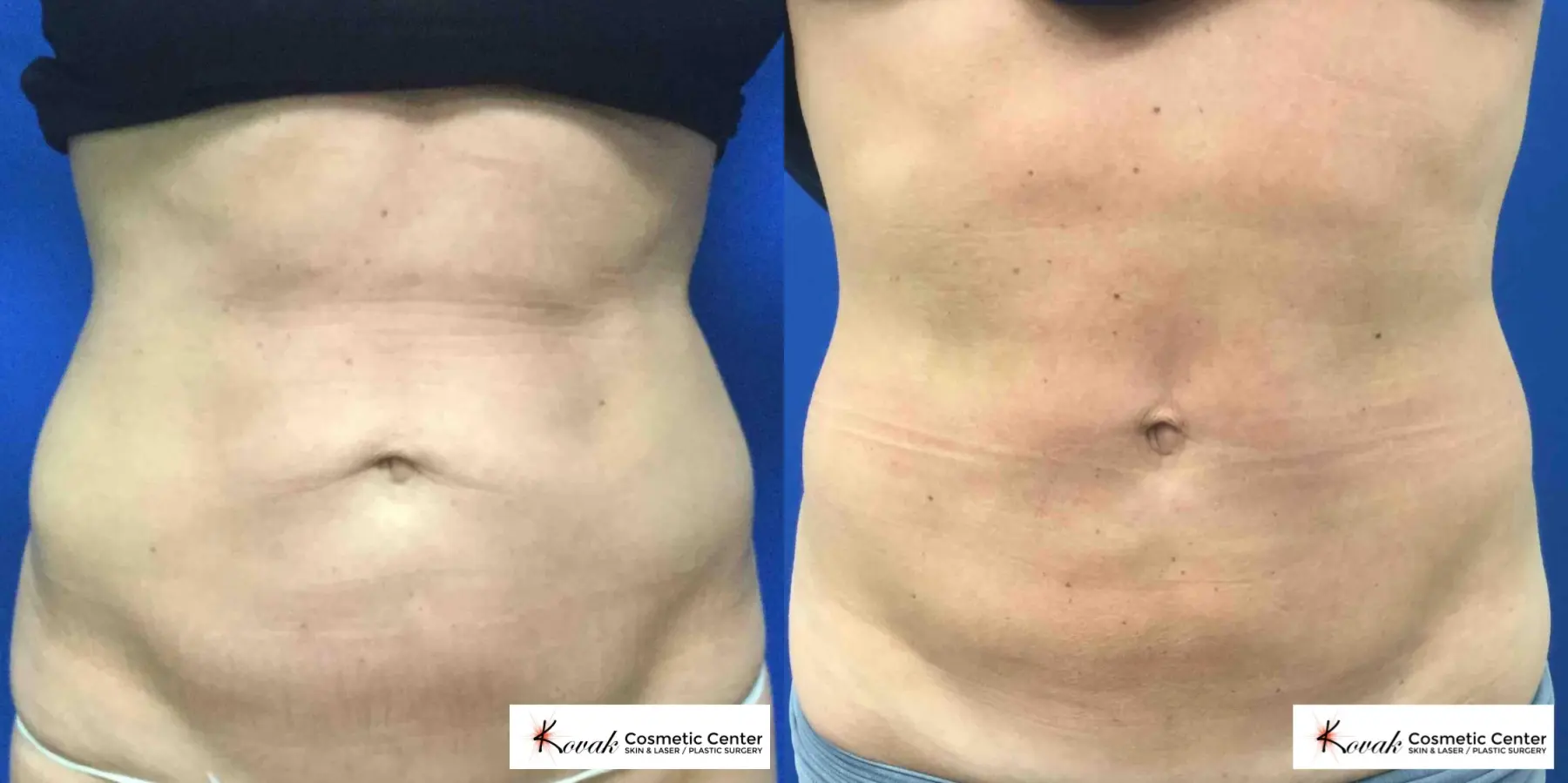 EMSCULPT®: Patient 2 - Before and After  