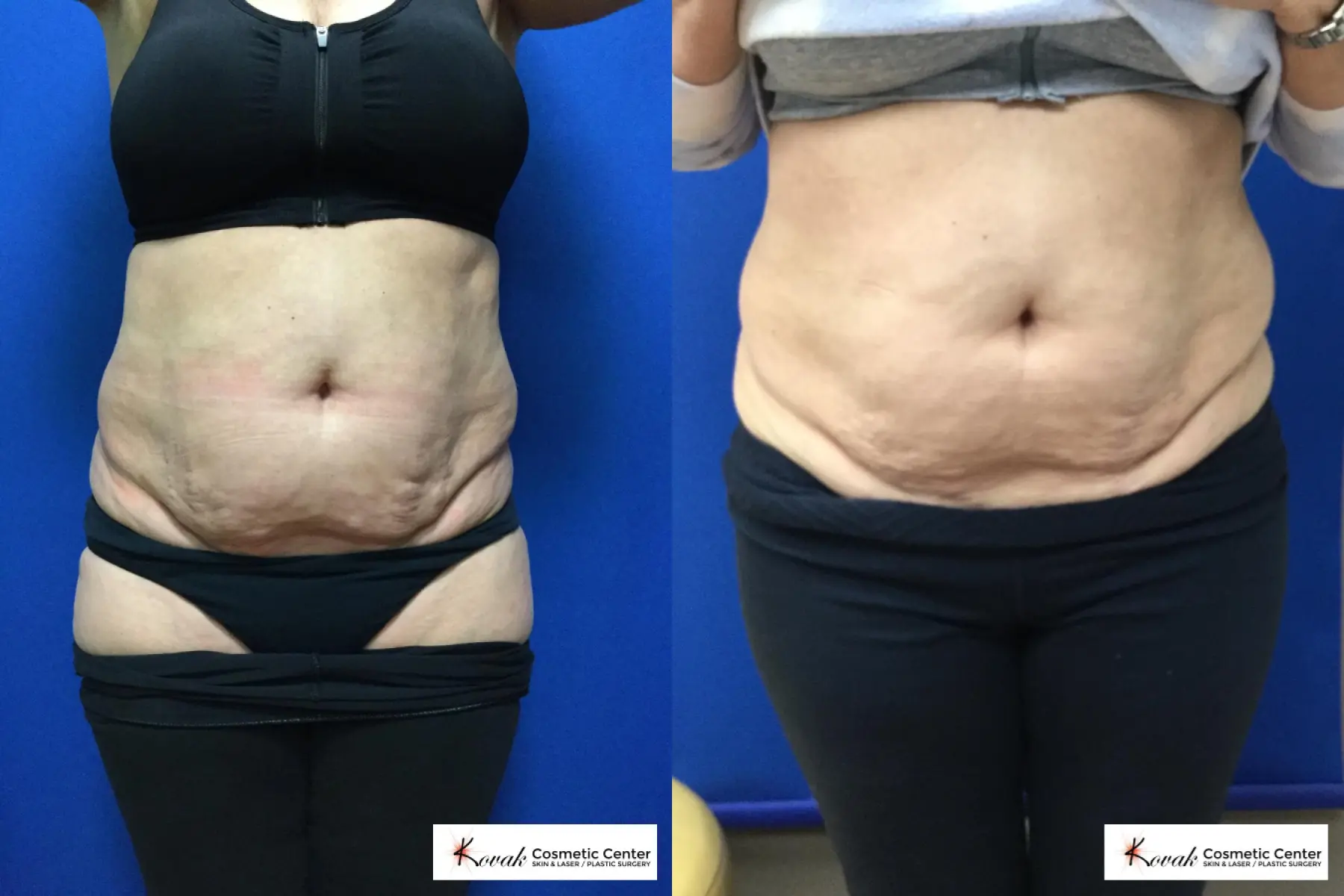 Emsculpt Neo on a 64 year old female - Before and After  