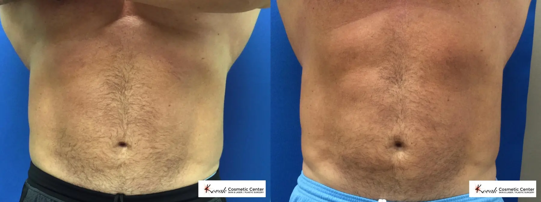 Combination of Emsculpt and Emsculpt Neo on a 50 year old male - Before and After  