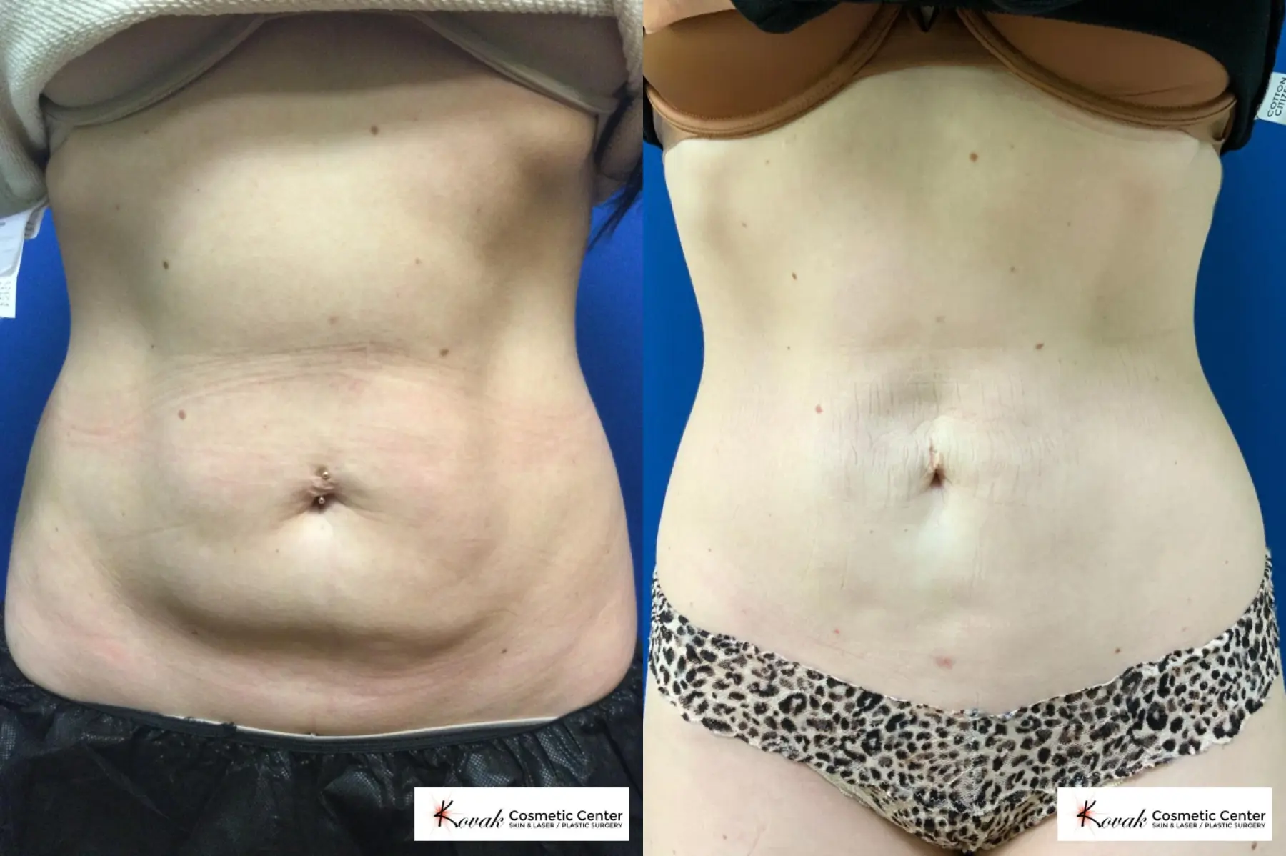  Vaser Liposuction with 8 Emsculpt Neo Treatments on a 28 year old woman - Before and After  