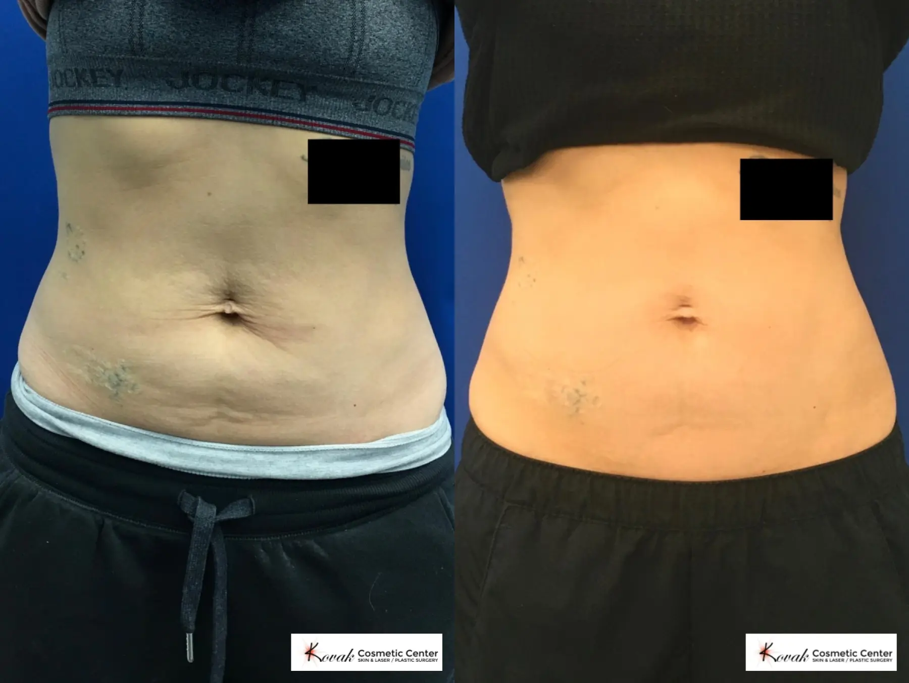 Emsculpt Neo for the abdomen on a 32 year old female  - Before and After  