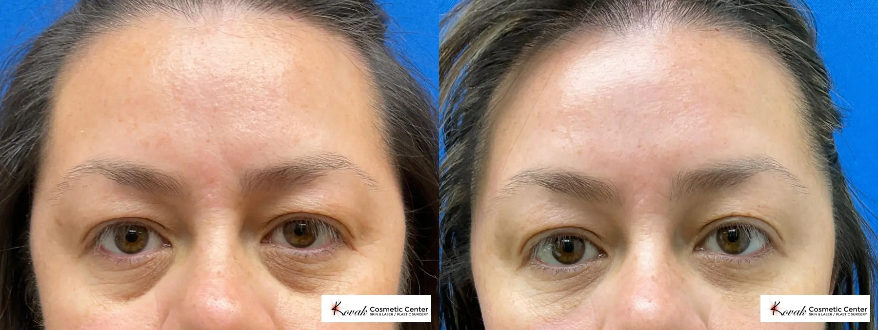 Dark Under Eye Circles using Restylane Silk on a 40 year old female - Before and After  