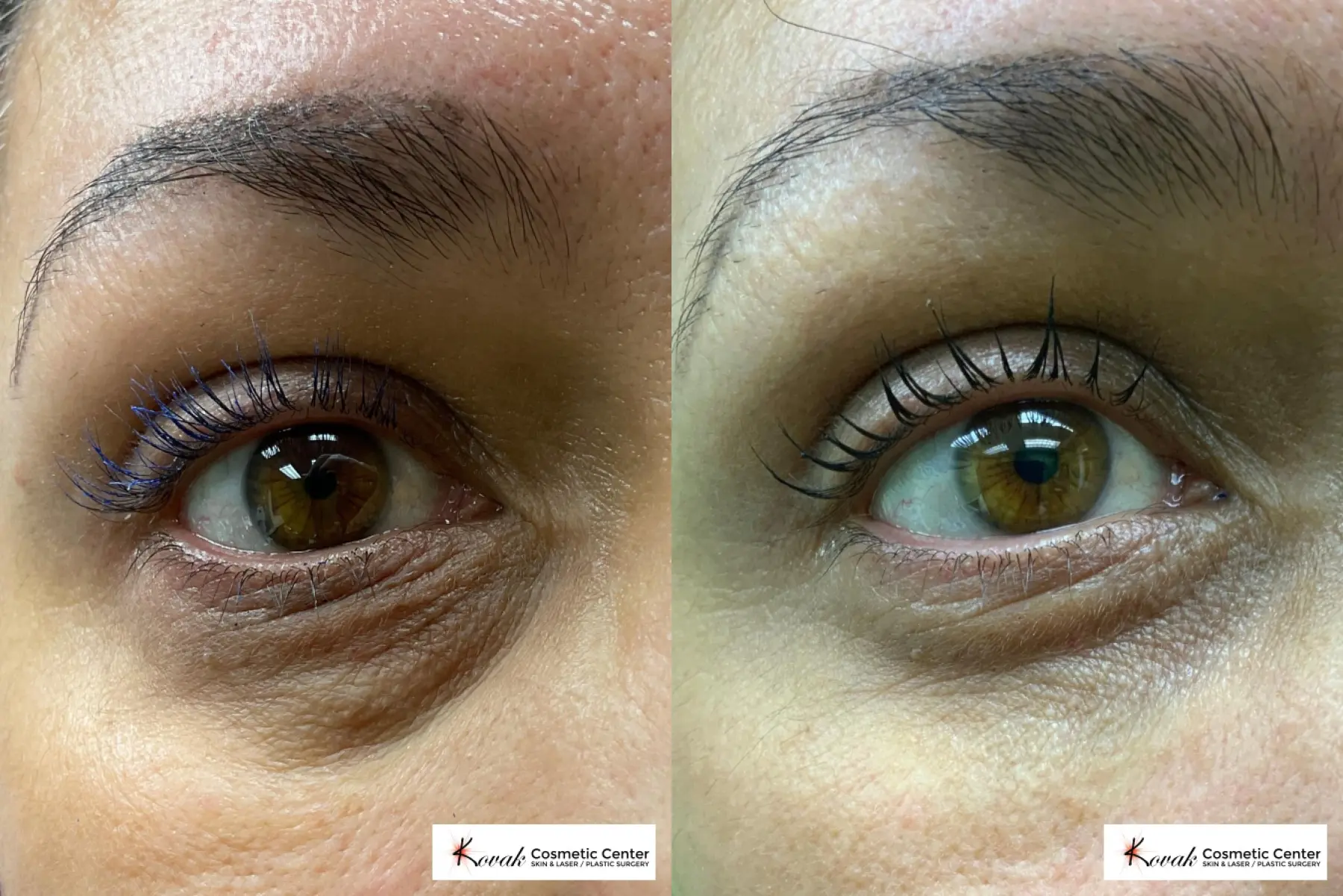 Under Eye Bag treatment using Restylane Silk on a 50 year old female - Before and After 1