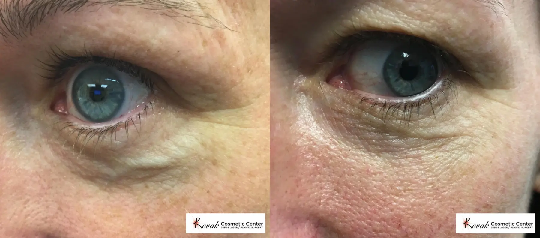 Eye vein treatment using the CoolTouch Varia on a 46 year old female - Before and After  
